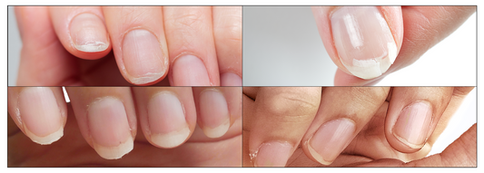 Top 5 Common Nail Problems and How to Fix Them